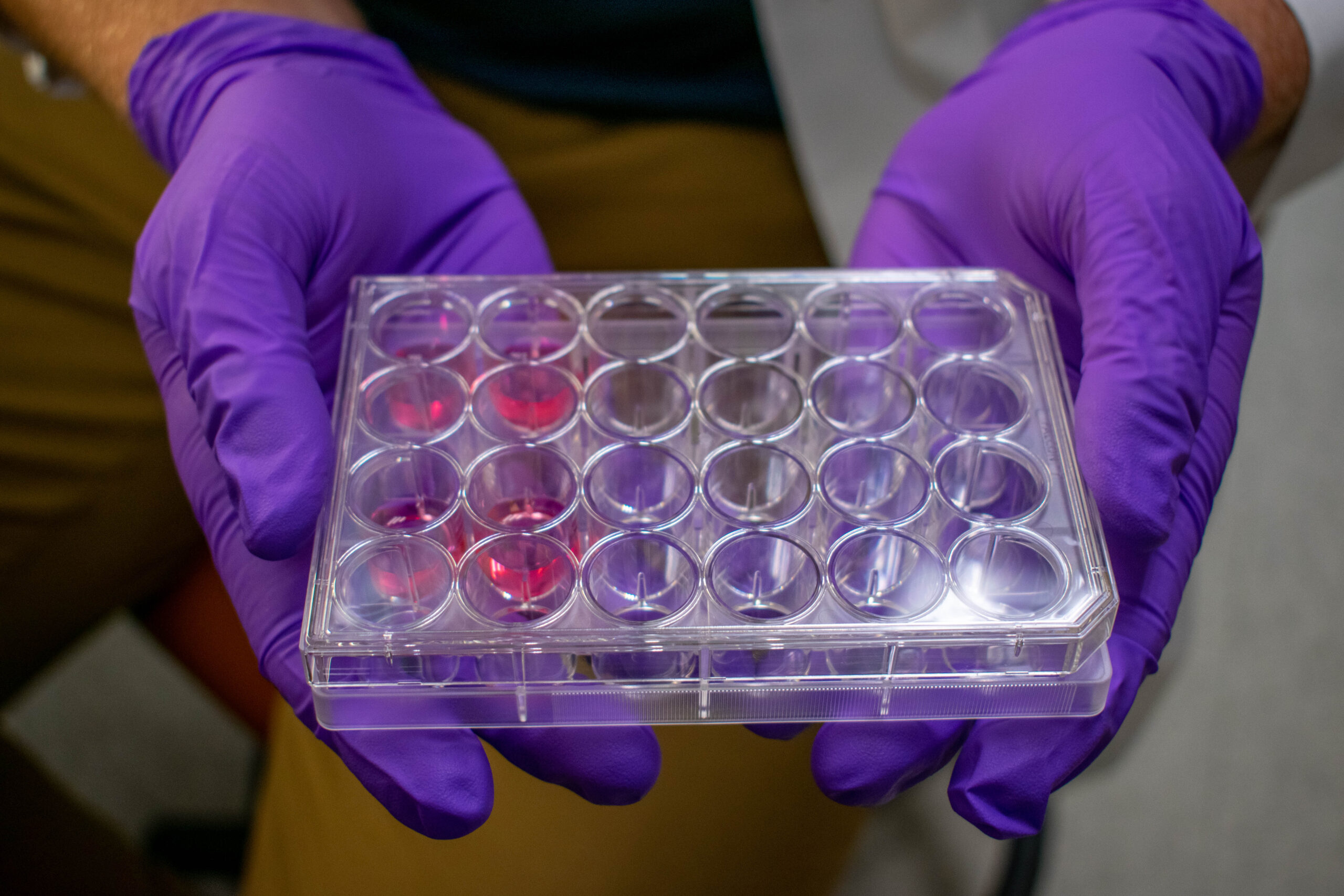 New, Rare Biobank Stores Samples Vital to Musculoskeletal Research